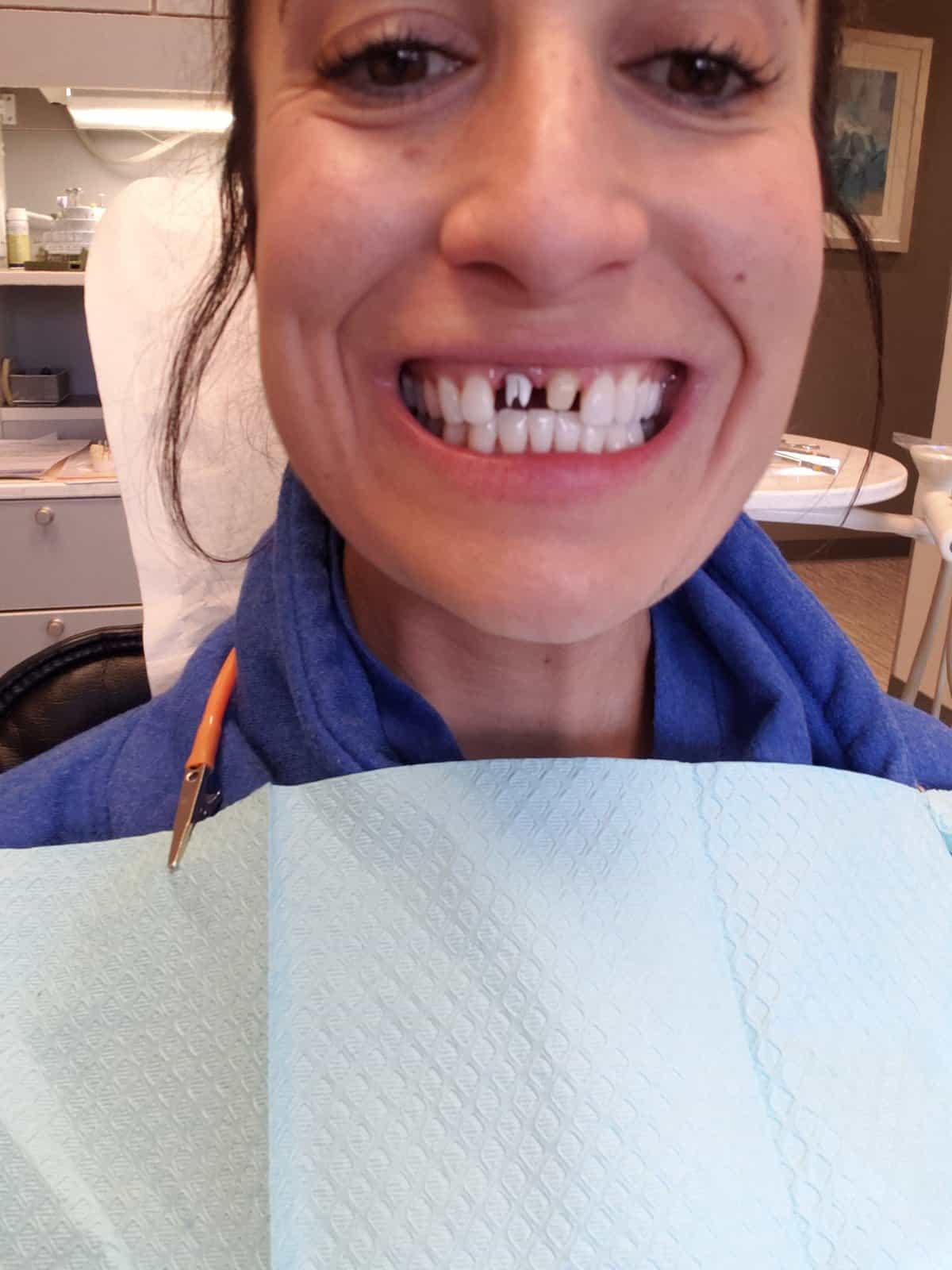 GROSSS! These are what my real tooth and my implant look like without the veneer (which goes over the tooth) and the implant veneer (which goes over the peg looking thing) it was a semi painless process and totally worth it! But not very pretty at all